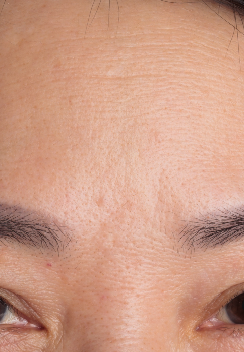 L’Or Céleste Ritual before and after — Forehead and brow comparison, participant 1 — after
