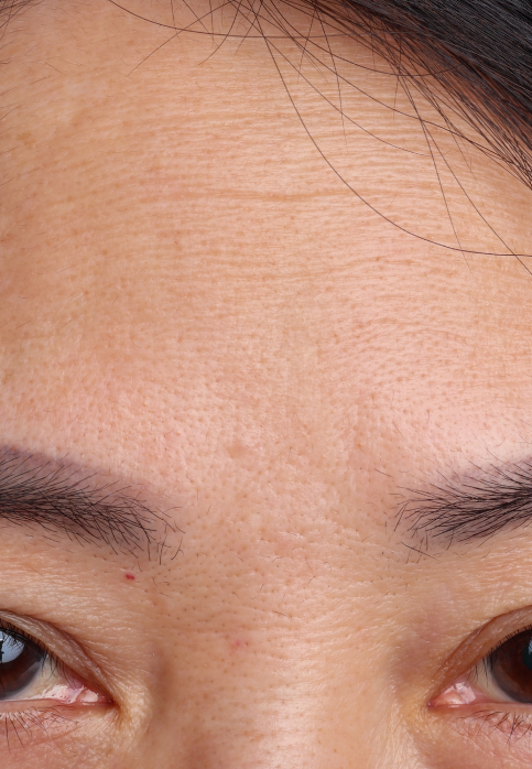 L’Or Céleste Ritual before and after — Forehead and brow comparison, participant 1 — before