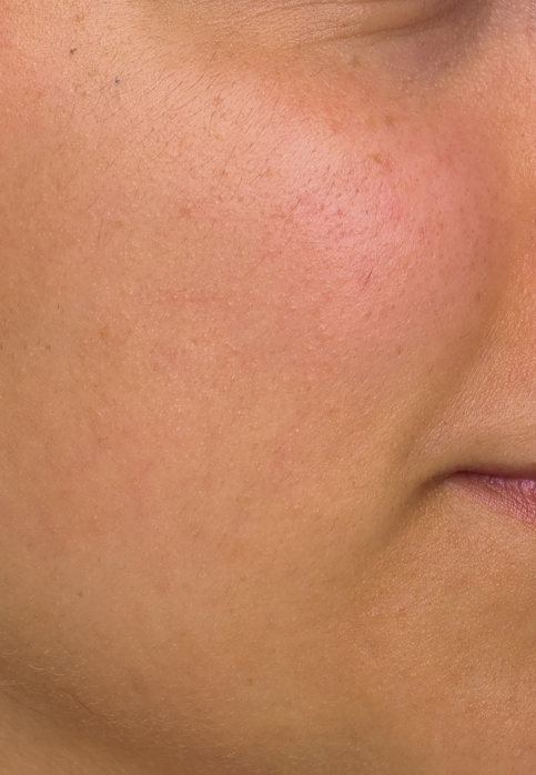 L’Or Céleste Ritual before and after — Right cheek comparison, participant 2 — before