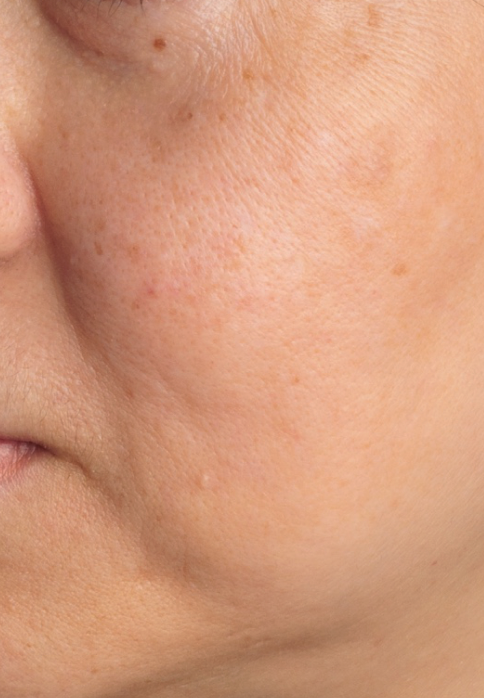 L’Or Céleste Ritual before and after — Cheek comparison, participant 1 — after