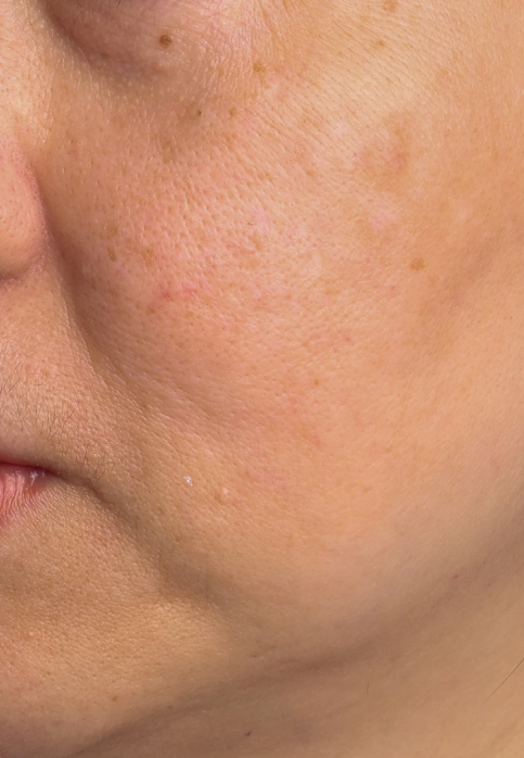 L’Or Céleste Ritual before and after — Cheek comparison, participant 1 — before