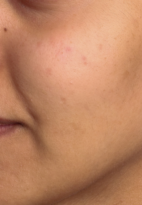L’Or Céleste Ritual before and after — Cheek comparison, participant 5 — before