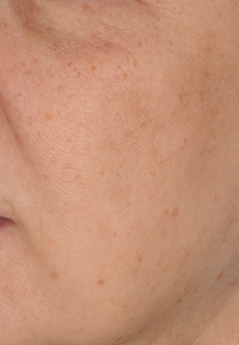 L’Or Céleste Ritual before and after — Left cheek comparison, participant 6 — after