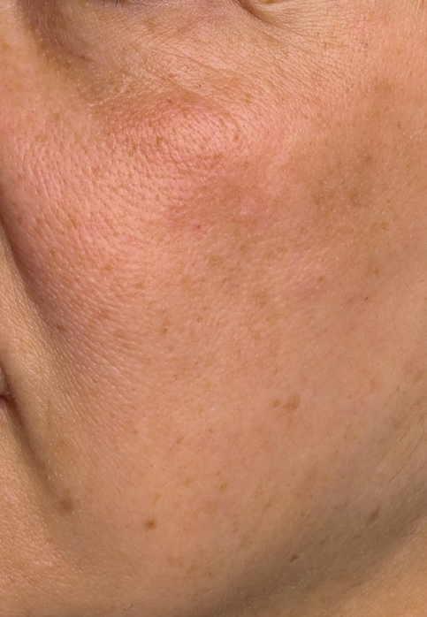 L’Or Céleste Ritual before and after — Left cheek comparison, participant 6 — before