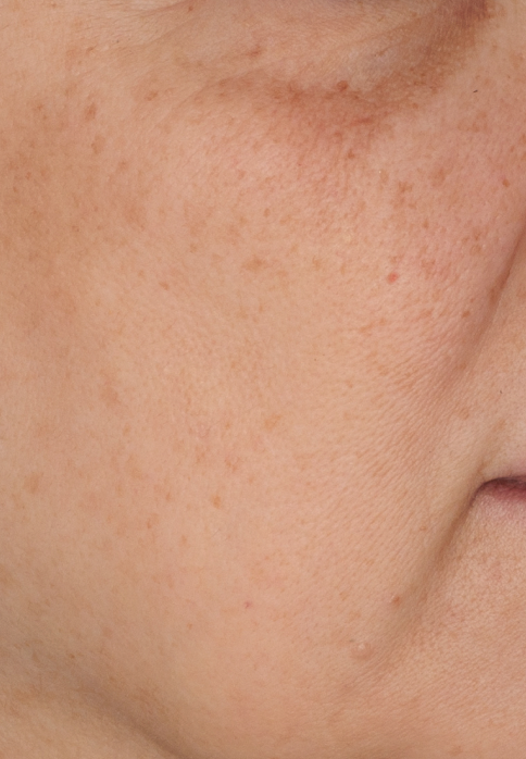 L’Or Céleste Ritual before and after — Right cheek comparison, participant 6 — after