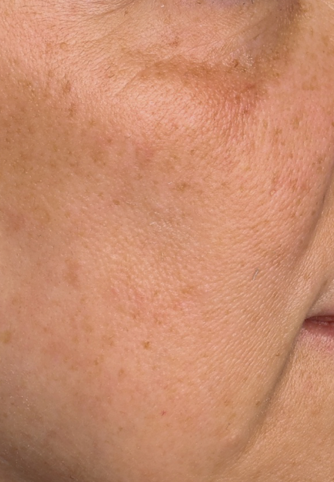 L’Or Céleste Ritual before and after — Right cheek comparison, participant 6 — before