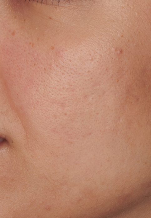 L’Or Céleste Ritual before and after — Left cheek comparison, participant 7 — after