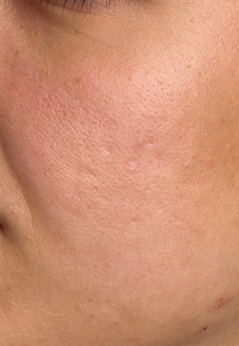 L’Or Céleste Ritual before and after — Left cheek comparison, participant 7 — before