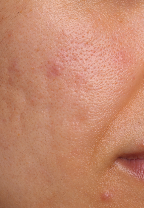 L’Or Céleste Ritual before and after — Right cheek comparison, participant 7 — before
