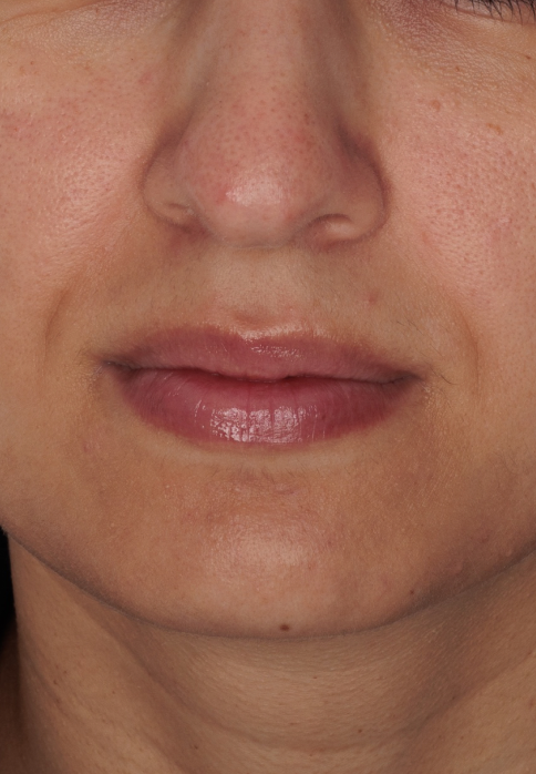 L’Or Céleste Ritual before and after — Lower face comparison, participant 7 — after