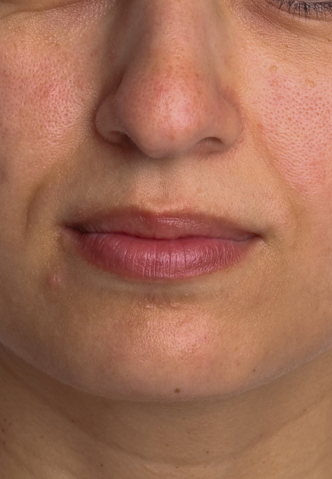 L’Or Céleste Ritual before and after — Lower face comparison, participant 7 — before