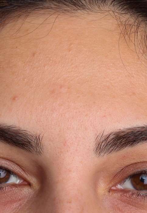 L’Or Céleste Ritual before and after — Forehead and brow comparison, participant 8 — before