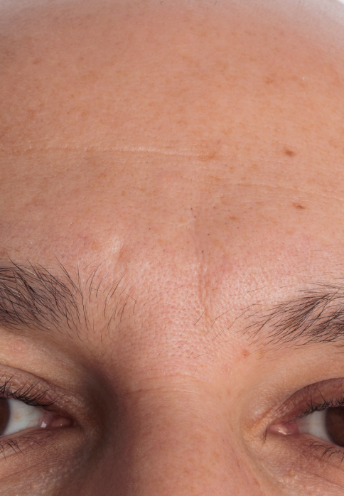 L’Or Céleste Ritual before and after — Forehead and brow comparison, participant 9 — after