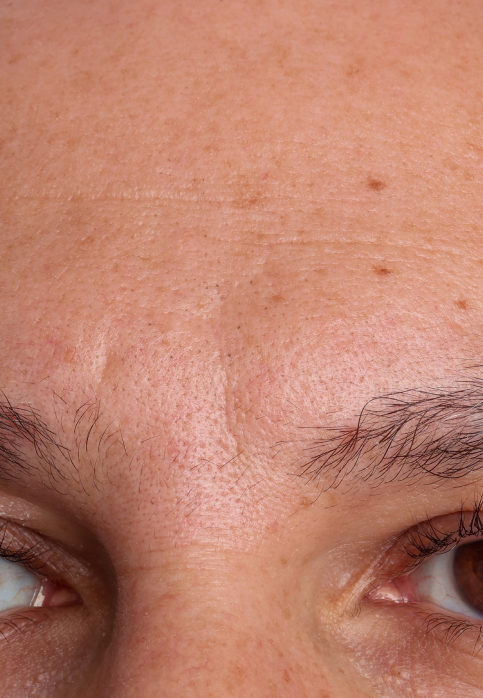 L’Or Céleste Ritual before and after — Forehead and brow comparison, participant 9 — before