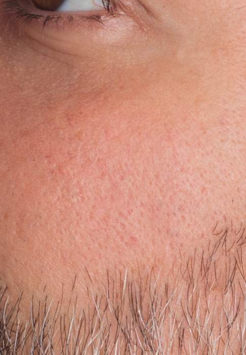 L’Or Céleste Ritual before and after — Cheek comparison, participant 11 — after