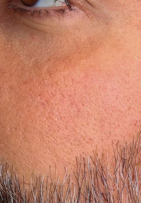 L’Or Céleste Ritual before and after — Cheek comparison, participant 11 — before
