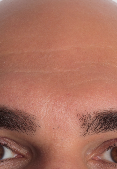 L’Or Céleste Ritual before and after — Forehead and brow comparison, participant 11 — after