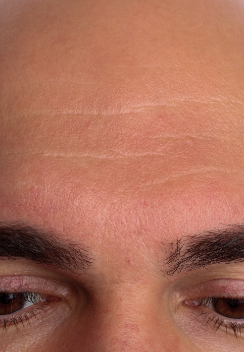 L’Or Céleste Ritual before and after — Forehead and brow comparison, participant 11 — before